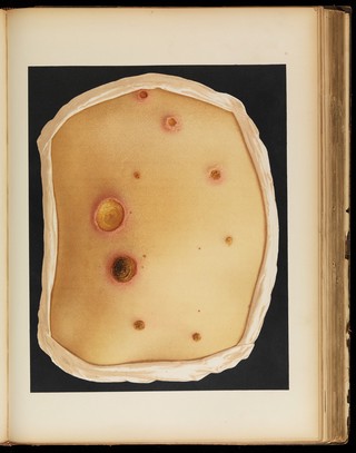 Iconographie des maladies cutanées et syphilitiques : avec texte explicatif / Le Musée de l'Hôpital Saint-Louis ; par Ernest Besnier [and others].