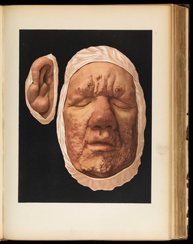 Iconographie des maladies cutanées et syphilitiques : avec texte explicatif / Le Musée de l'Hôpital Saint-Louis ; par Ernest Besnier [and others].