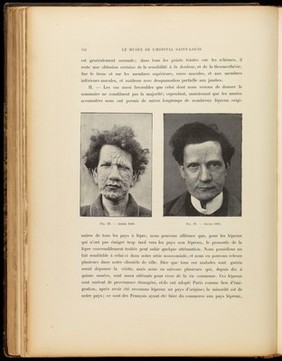 Iconographie des maladies cutanées et syphilitiques : avec texte explicatif / Le Musée de l'Hôpital Saint-Louis ; par Ernest Besnier [and others].