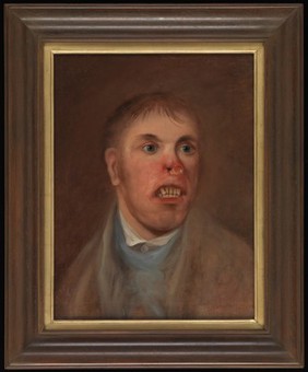 A young man, J. Kay, afflicted with a disease which has eaten away part of his face. Oil painting, ca. 1820.