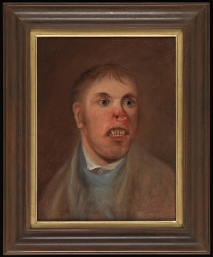 A young man, J. Kay, afflicted with a disease which has eaten away part of his face. Oil painting, ca. 1820.