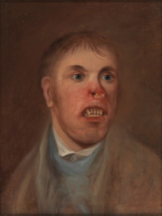 A young man, J. Kay, afflicted with a disease which has eaten away part of his face. Oil painting, ca. 1820.