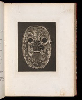 Atlas of head sections : fifty-three engraved copperplates of frozen sections of the head and fifty-three key plates with descriptive texts / by William Macewen.