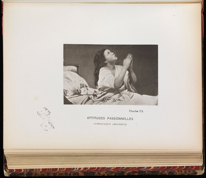 Iconographie photographique de la Salpêtrière : service de M. Charcot / par Bourneville et P. Regnard.