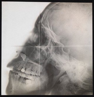 X-ray of a skull, in profile. Photograph, ca. 1915.