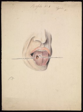 A diseased area of tissue on the tongue of a man suffering from syphilis, being held open by two small metal hooks on chains. Watercolour by C. D'Alton, 1858.