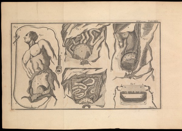 Plate illustrating the position and state of the bladder.