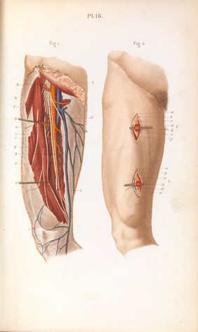 Plate 16, Ligature of the femoral artery.