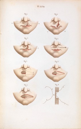 Précis iconographique de médecine opératoire et d'anatomie chirurgicale / [Claude Bernard].