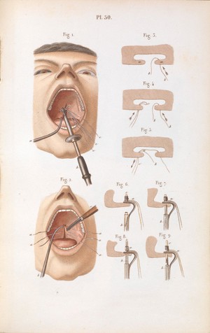 view Plate 50, Surgical technique for cleft palate.