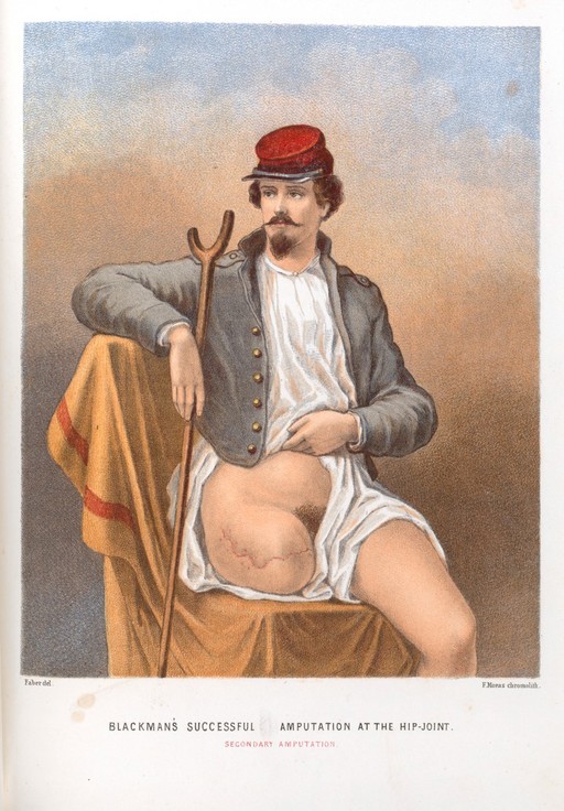 American Civil War veteran, with an amputated leg at the hip.