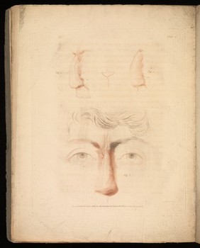 An account of two successful operations for restoring a lost nose from the integuments of the forehead in the cases of two officers of His Majesty's Army; to which are prefixed historical and physiological remarks on the nasal operation; including descriptions of the Indian and Italian methods / [J.C. Carpue].