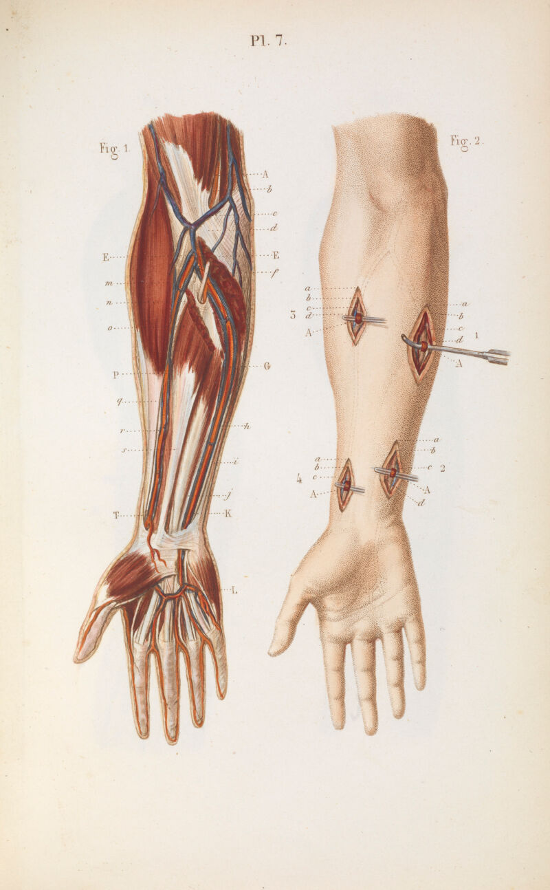 Plate 7, Ligature of the ulnar and radial arteries. | Wellcome Collection