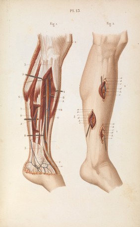 Plate 13, Ligature of the anterior tibial artery.