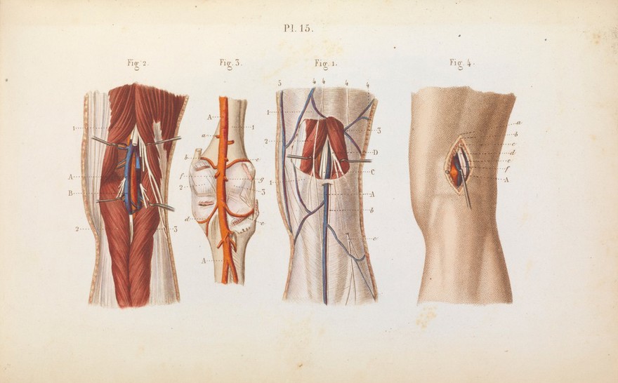 Précis iconographique de médecine opératoire et d'anatomie chirurgicale / [Claude Bernard].
