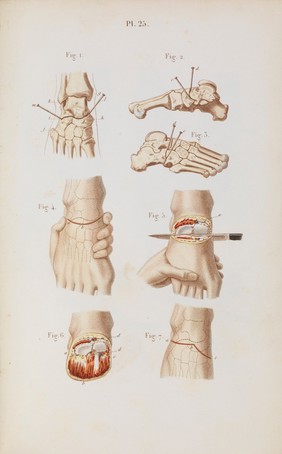 Précis iconographique de médecine opératoire et d'anatomie chirurgicale / [Claude Bernard].