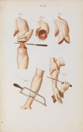 Précis iconographique de médecine opératoire et d'anatomie chirurgicale / [Claude Bernard].