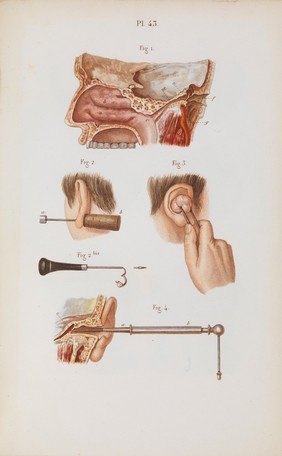 Précis iconographique de médecine opératoire et d'anatomie chirurgicale / [Claude Bernard].