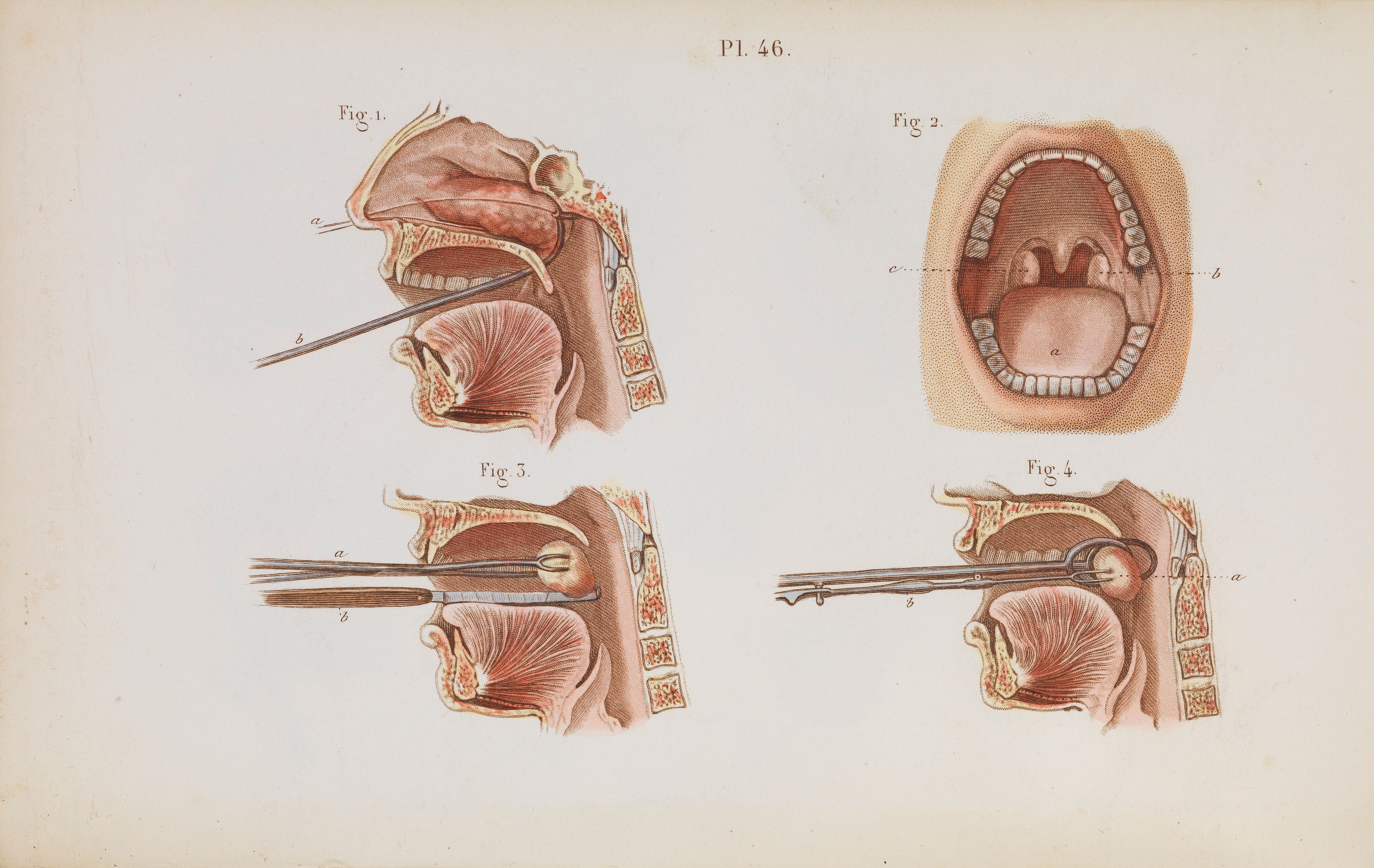 plate-46-the-removal-of-nasal-polyps-and-tonsillectomy-wellcome