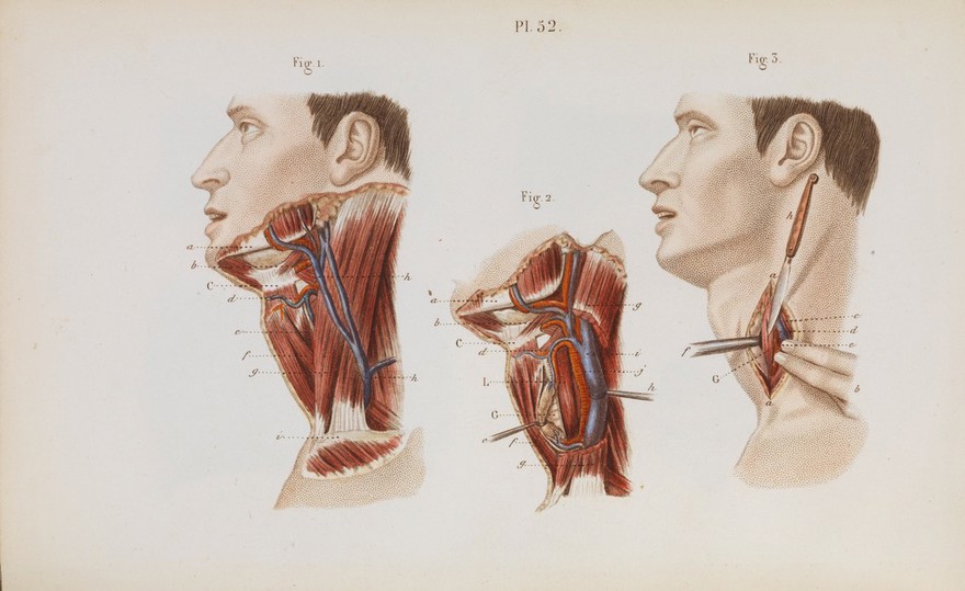 Précis iconographique de médecine opératoire et d'anatomie chirurgicale / [Claude Bernard].