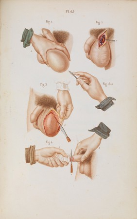 Précis iconographique de médecine opératoire et d'anatomie chirurgicale / [Claude Bernard].