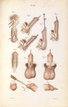 Précis iconographique de médecine opératoire et d'anatomie chirurgicale / [Claude Bernard].