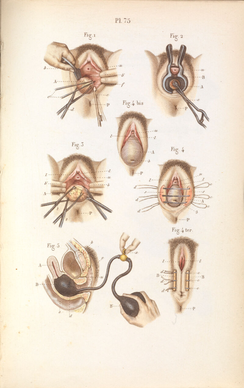 Plate 75, Surgery - uterine polyps, prolapsed uterus. | Wellcome Collection