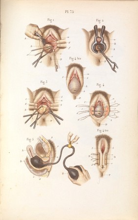 Précis iconographique de médecine opératoire et d'anatomie chirurgicale / [Claude Bernard].