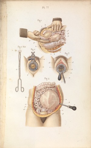 view Plate 77, Dilation of cervix and preforation of membrane.