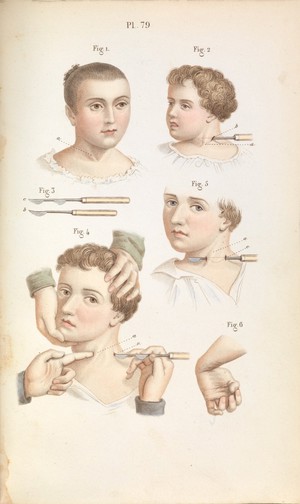 view Plate 79, Surgical techniques for torticollis and club hand.