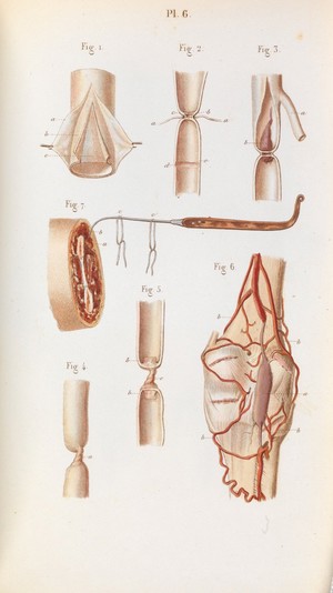 view Plate 6, Ligature of arteries in the leg.