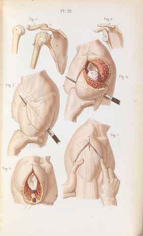 Précis iconographique de médecine opératoire et d'anatomie chirurgicale / [Claude Bernard].