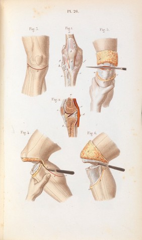 Précis iconographique de médecine opératoire et d'anatomie chirurgicale / [Claude Bernard].