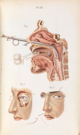 Précis iconographique de médecine opératoire et d'anatomie chirurgicale / [Claude Bernard].