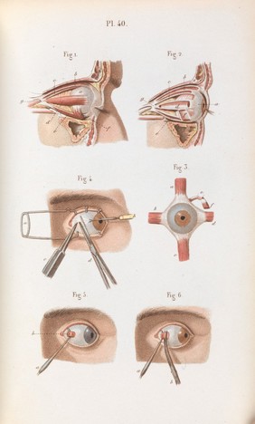 Précis iconographique de médecine opératoire et d'anatomie chirurgicale / [Claude Bernard].