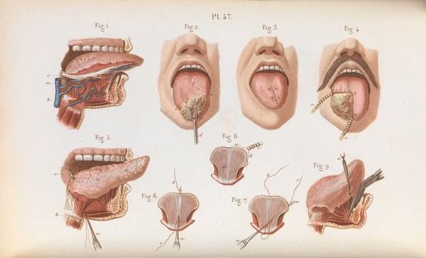 Précis iconographique de médecine opératoire et d'anatomie chirurgicale / [Claude Bernard].