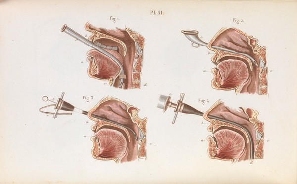 Précis iconographique de médecine opératoire et d'anatomie chirurgicale / [Claude Bernard].