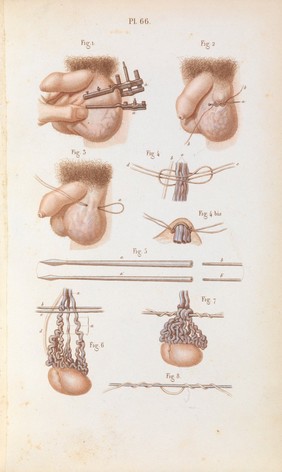 Précis iconographique de médecine opératoire et d'anatomie chirurgicale / [Claude Bernard].