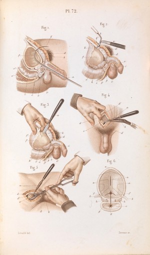 view Plate 72, Surgical removal of a stone from the bladder.