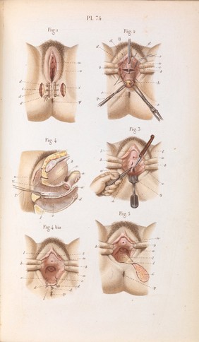 Plate 74, Surgical technique for vaginal fistulas.