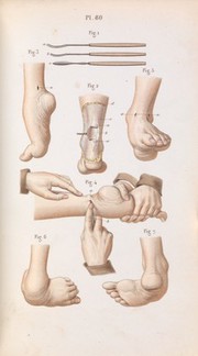 Plate 80, Surgical technique to repair club foot.