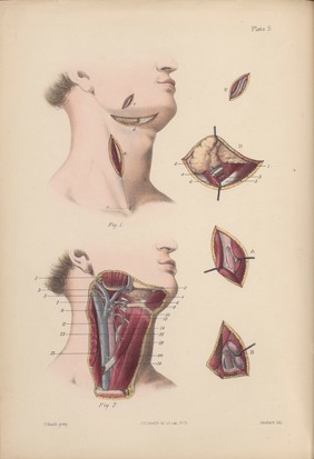 A course of operative surgery / with plates drawn from nature by M. Léveillé and coloured by hand under his direction ; by Christopher Heath.