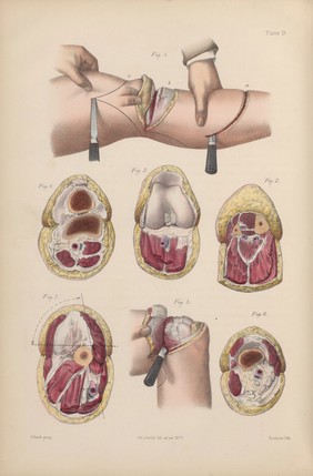 Plate 19, Amputation of leg, knee, and thigh.