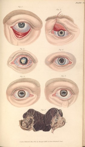 Lectures on the operative surgery of the eye : or, an historical and critical inquiry into the methods recommended for the cure of cataract, for the formation of an artificial pupil, &c. &c. &c. Containing a new method of operating for cataract by extraction. Being the substance of that part of the author's course of lectures on the principles and practice of surgery which relates to the operations on that organ / By G. J. Guthrie.