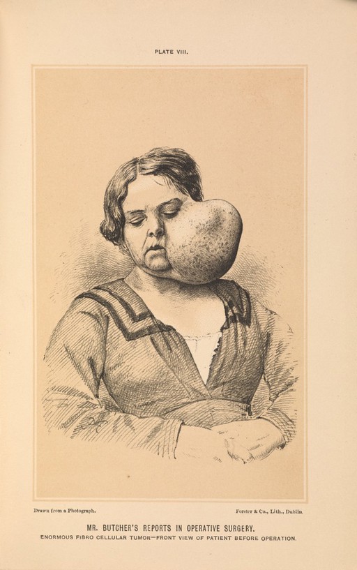 Plate VIII. Woman with an enormous fibrocellular tumor, 1877.