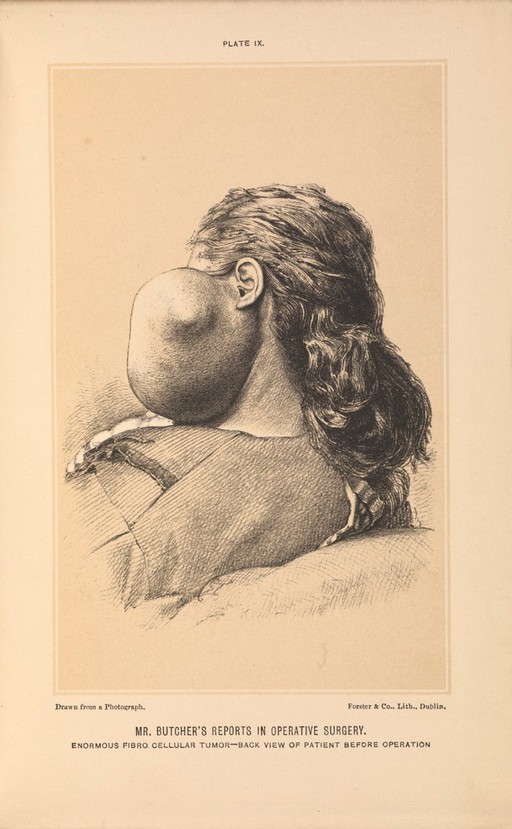 Plate IX. Woman with an enormous fibrocellular tumor, 1877.