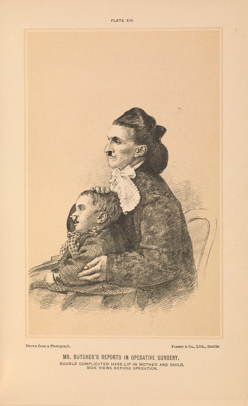 Plate XIII. Double complicated hare-lip in mother and child.
