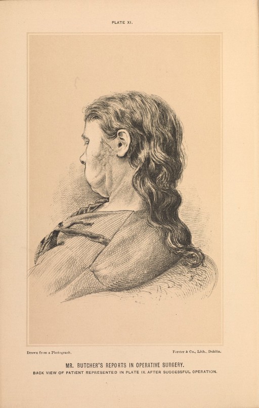 Plate XI. Back view of patient after successful operation.