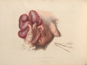 view Plate VI, Surgical technique for a scrotal hernia. 