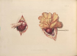 view Plate VIII, Illustration of a femoral hernia. 